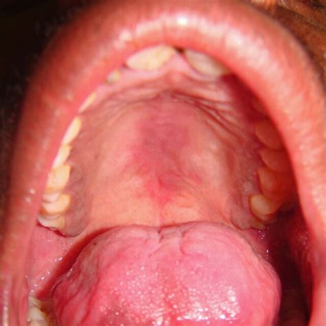 Chronic erythematous candidiasis affecting the palate | Download ...