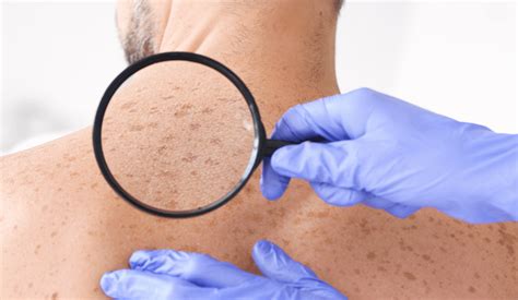 What Causes White Spots on Skin? | Risks and Treatments | DCSI