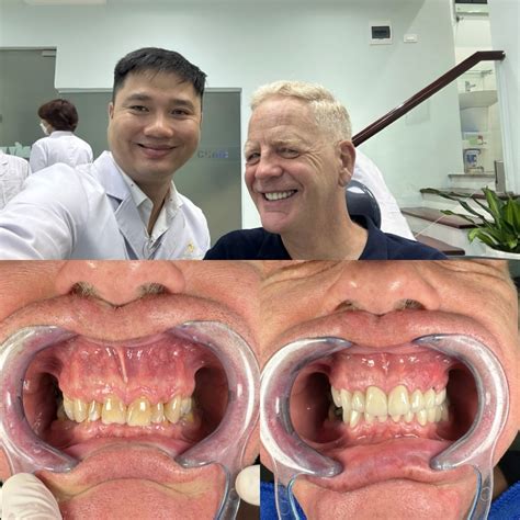 New smile with raising vertical... - Australian Dental Clinic