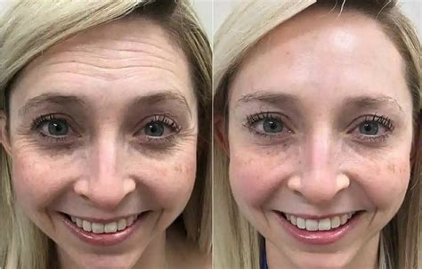 Botox Antes E Depois