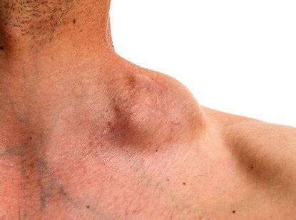lump  bump  top  shoulder  treatment