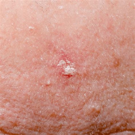 71 Basal Cell Papilloma Royalty-Free Images, Stock Photos & Pictures ...