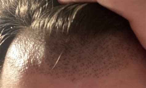 FUE Graft Removal - Hair Restoration Questions and Answers - Hair ...