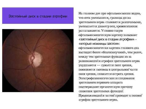 Застойный диск зрительного нерва Выполнила Исаханян Ани МЛ