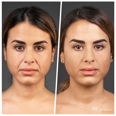 nasolabial fold  treatments  nasolabial folds  marionette