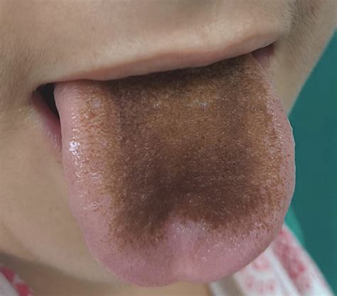 This image depicts discoloured hypertrophic elongated papillae on the ...