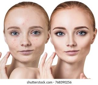 Young Woman Acne Before After Treatment Stock Photo 768390256 ...