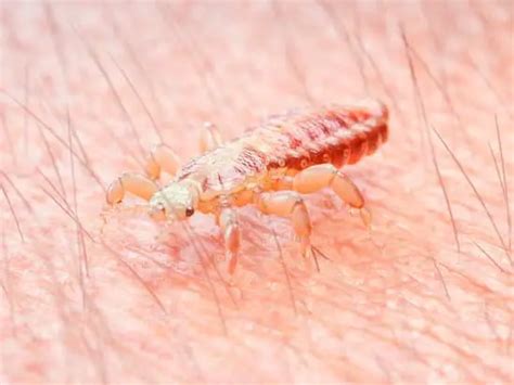 Head Lice - How to Detect and Get Rid of Children's Head Lice ...