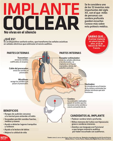 Implante coclear, características y beneficios | Poblanerías en línea