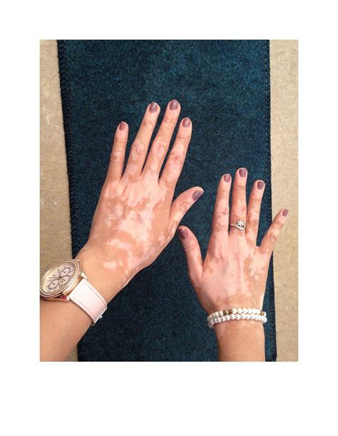 Vitiligo Disorder Their Symptoms and Treatment Options