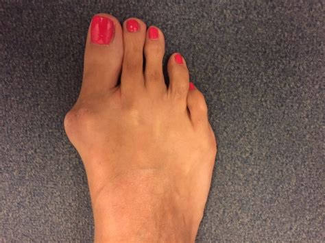 Hallux Valgus Bunions | European Foot Institute