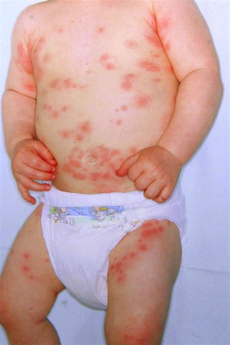 Baby Hives Hives In Babies | BabyCenter