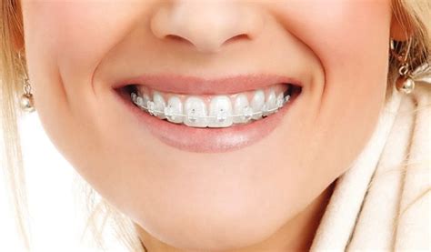 Brackets Transparentes | Cómo Funcionan y Cuánto Cuestan