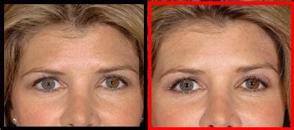 Cabarrus Eye Center, Concord NC: Advantages of Restylane injections