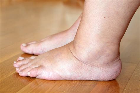 Could My Swollen Feet Be Tied To My Diet? | Cone Health