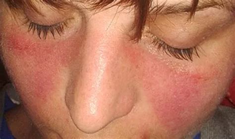 mengenal autoimun sle penyakit  diderita isyana sarasvati akurat