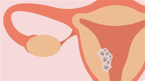 Cancer Symptom Info: A Guide To All Five Gynaecological Cancers ...