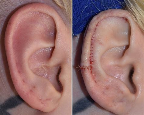 » Blog ArchiveOR Snapshots - Vertical Ear Reduction with Scaphal Resection