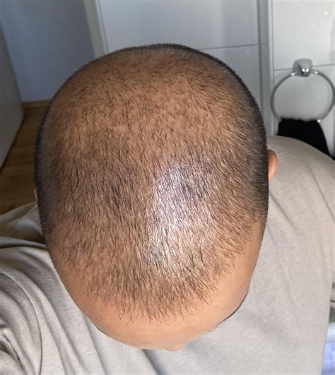 6 month update - MWF Fin 1mg, Min every day : r/tressless