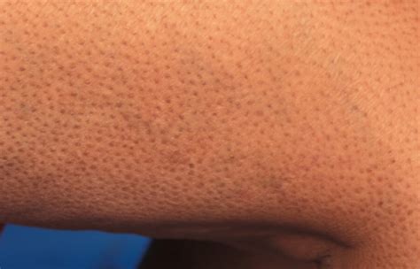 Skin Manifestations of Diabetes Mellitus - Endotext - NCBI Bookshelf