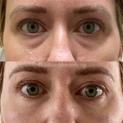 Say goodbye to tired eyes!😴 Tear trough (under eye) filler is used to