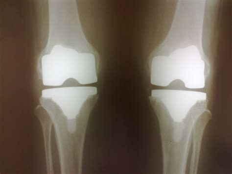 Joint Replacements Gallery - DOCJOINTS//DR SUJIT JOS//Total joint