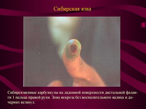Сибирская язва - презентация онлайн