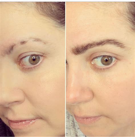 Trichotillomania Eyebrows