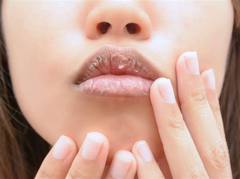rid  swollen lip heal treat  reduce lip swelling