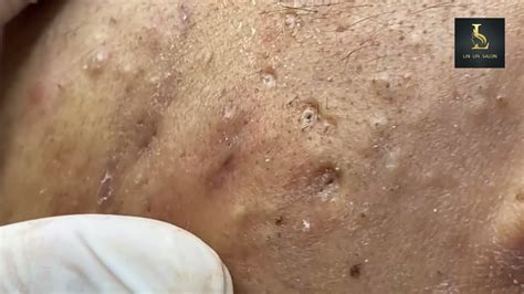 Unbelievable Blackhead Removal 2024: The Best Treatments Reviewed and Ranked - hkfuquo