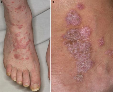 Lichen Planus Skin Rash