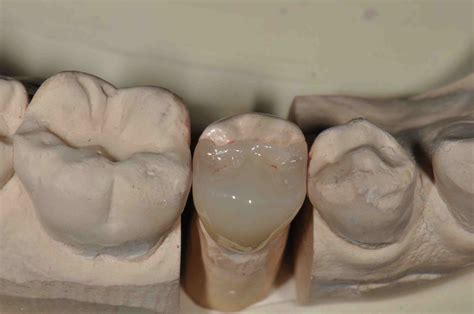 NX3 Cures Optibond XTR - Lee Ann Brady, DMD's Dental Blog