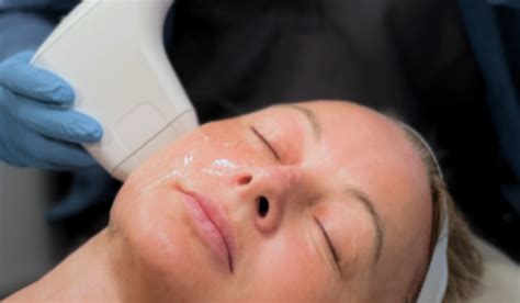 sofwave skin tightening portland falmouth waterville