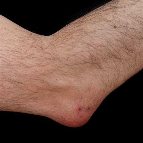 infected olecranon bursitis