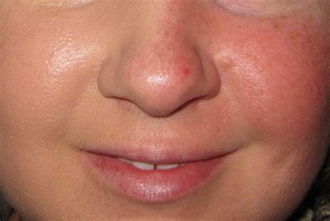 Redness - Mayoral Dermatology