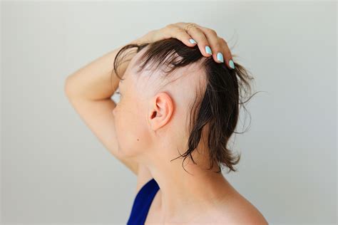 Experts Review Key Factors in Alopecia Areata Severity and Morbidity