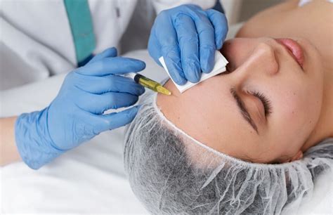 light chemical peel chemical peeling