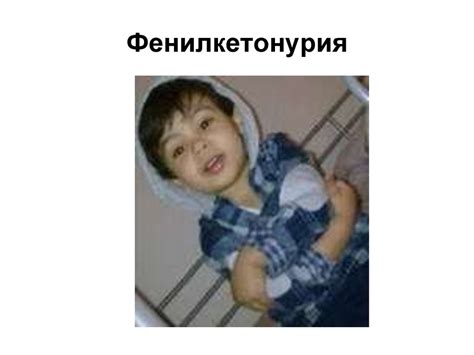 Фенилкетонурия - online presentation