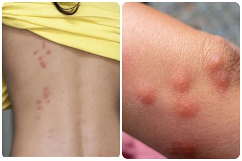 Cómo son las picaduras de chinches y como diferenciarlas de otros