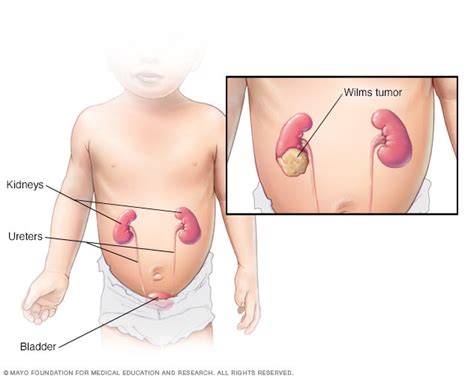 Wilms Tumor: Understanding Pediatric Kidney Cancer