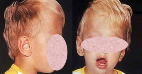 Macrocephaly: causes, symptoms and treatment