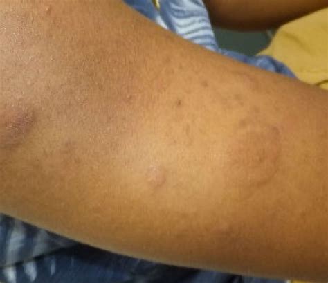 Image:Lupus erythematodes Tumidus-MSD Manual Profi-Ausgabe