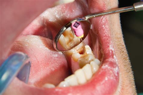 Root Canal Procedure