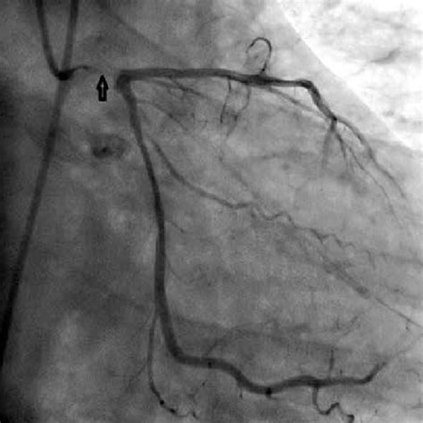 Coronary angiography shows total occlusion of the left main coronary ...