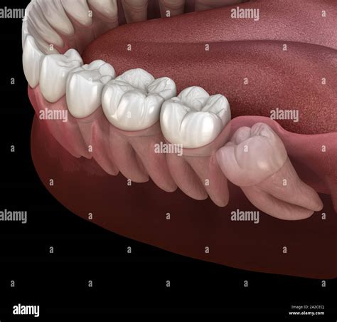 Healthy teeth and wisdom tooth with mesial impaction . Medically ...