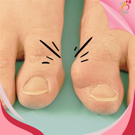Effective Solutions for Treating Bunions on Your Feet Naturally - Hunter Games Magazine