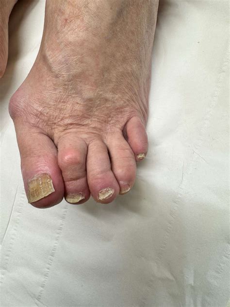 Understanding Fungal Nail Infections: Causes, Symptoms, and Treatments