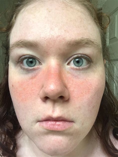 rash on the face 1