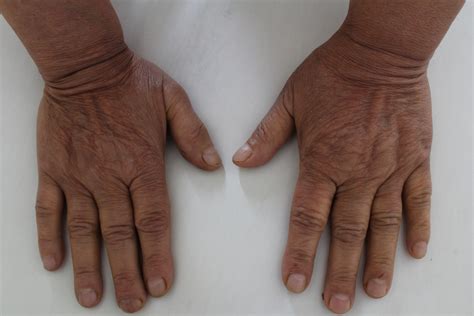 absence  sclerodactyly  digital ulcerations  scientific