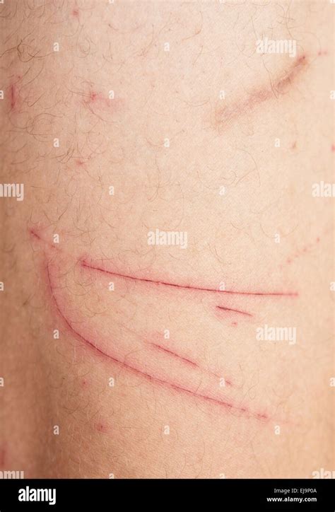 wound Stock Photo - Alamy